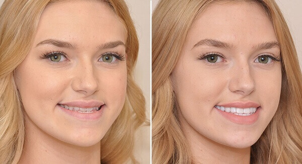 Tại Sao Cần Chỉnh Răng Móm?