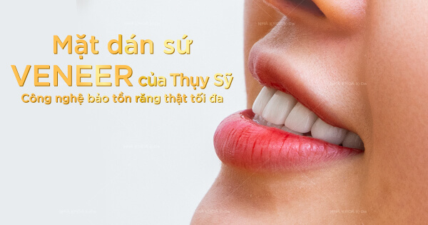 Mặt dán sứ Veneer – Công nghệ bảo tồn răng thật