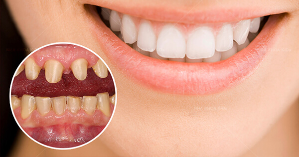 Răng Sứ Và Những Điều Có Thể Bạn Chưa Biết