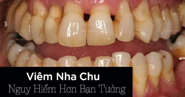 Viêm Nha Chu Nguy Hiểm Hơn Bạn Tưởng