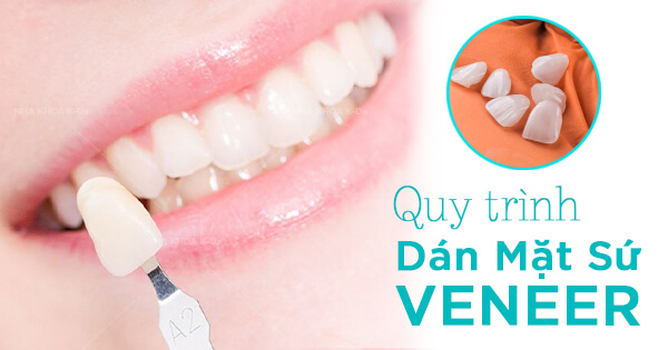 Quy Trình Dán Mặt Sứ Veneer