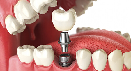 Cấy ghép Implant