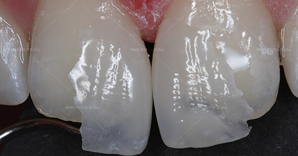 Mặt dán sứ Non-prep Veneer