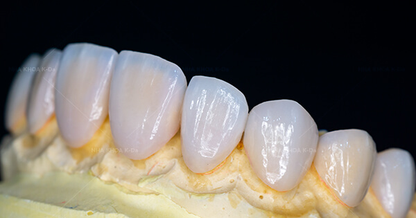 Mặt Dán Sứ Opal