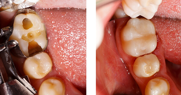 Trám Răng Thẩm Mỹ