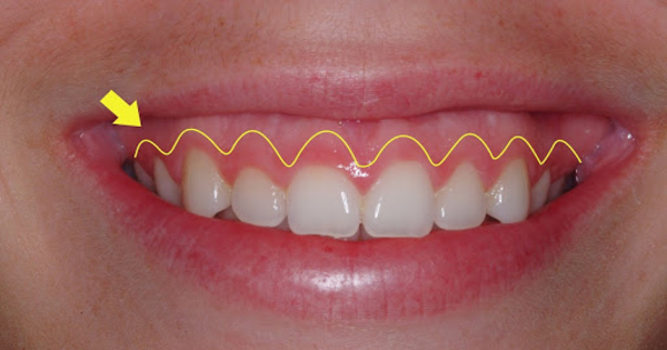 Tìm hiểu các phương pháp điều trị cười hở lợi hiện nay?