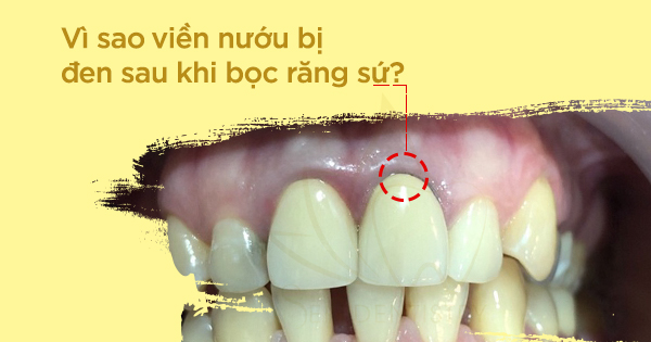 Vì sao viền nướu bị đen sau khi bọc răng sứ ?