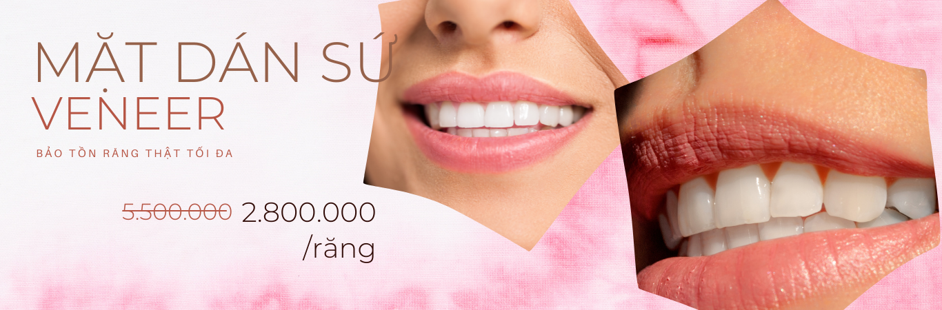 Mặt dán răng sứ veneer