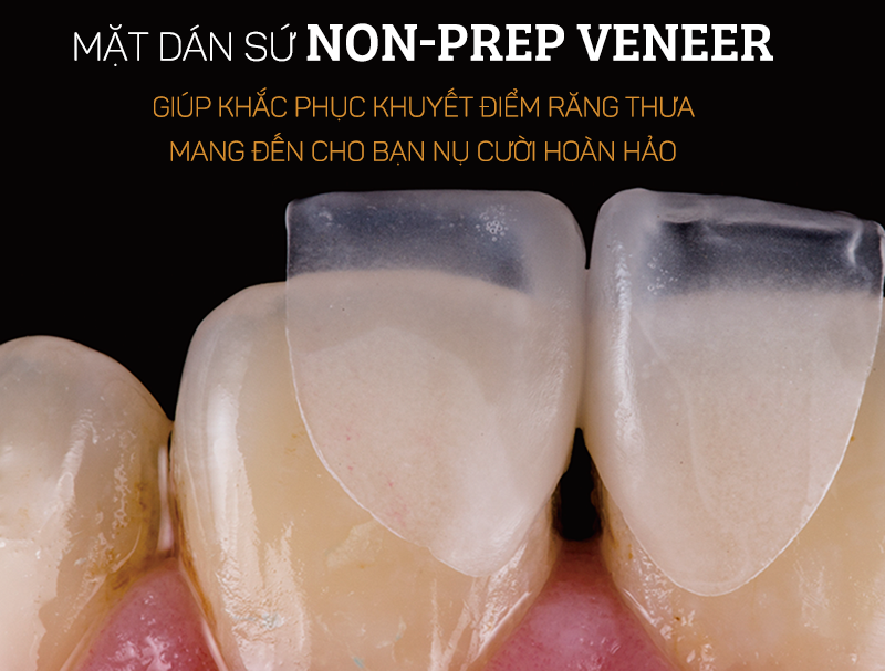 Mặt dán sứ Non-prep Veneer