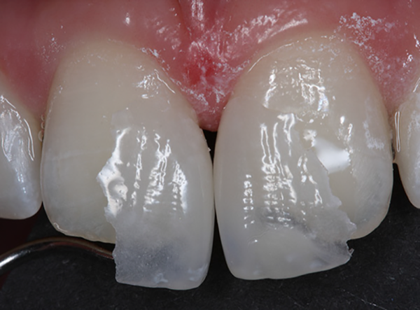 Mặt dán sứ Non-prep Veneer