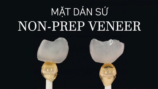 Mặt dán sứ Non-prep Veneer