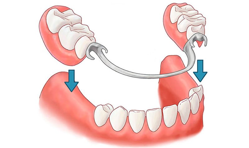 Làm hàm tháo lắp