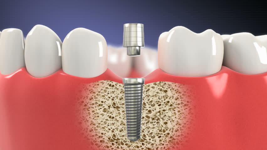 cấy ghép Implant