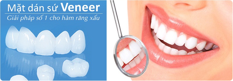 mặt dán sứ veneer