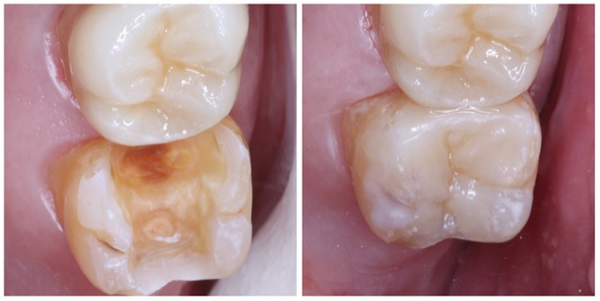 Inlay, Onlay và Overlay