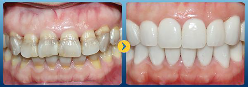 bọc răng sứ tại Nha Khoa Quốc Tế K-Da